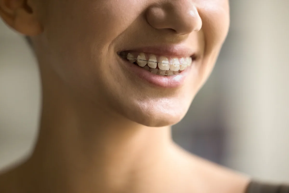 Adult Braces in Perth's North: What to Expect, Timelines and Costs