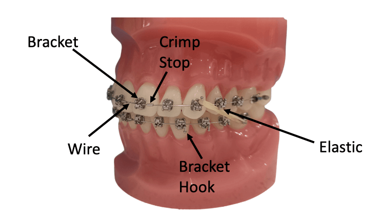 Parts of braces